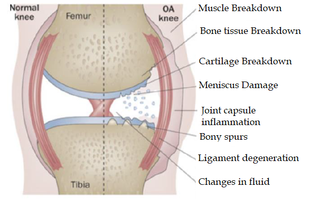 Osteoarthritis