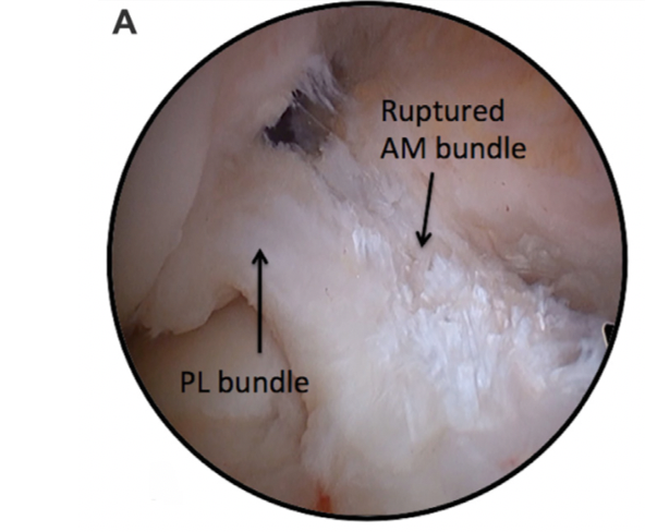 acl-tear-brisbane-knee-and-shoulder-clinic-dr-kelly