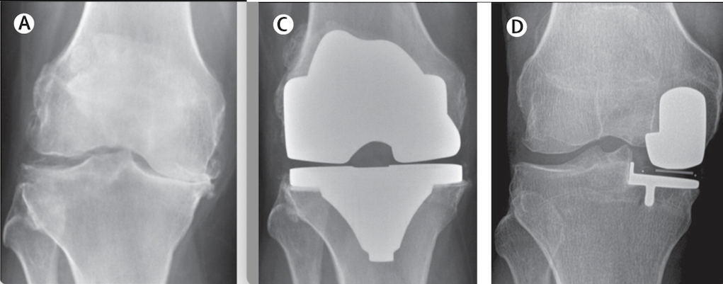 How do I Know When I Need a Knee Replacement?