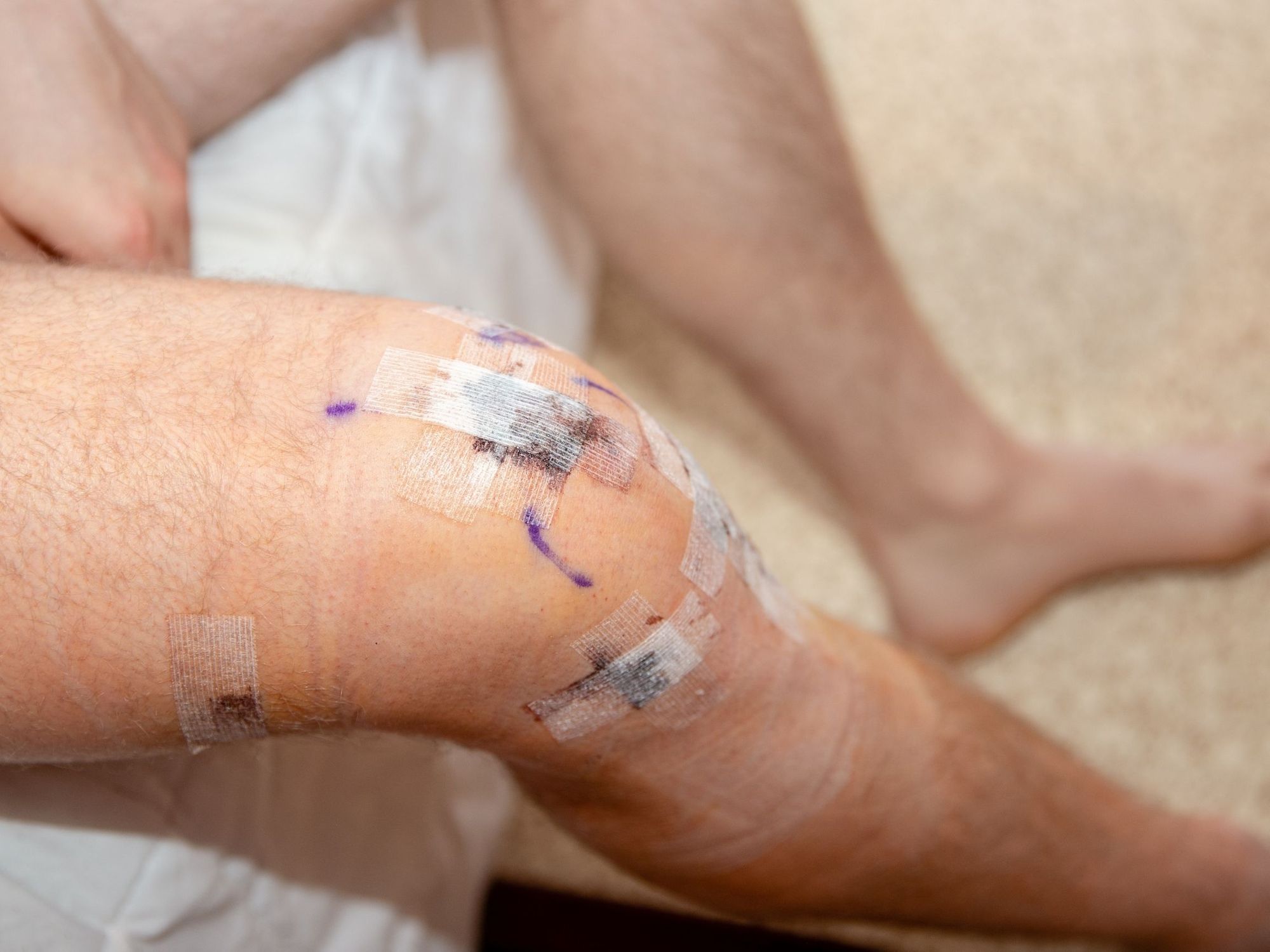 What Are the Most Common Areas for an ACL Graft? | Curovate