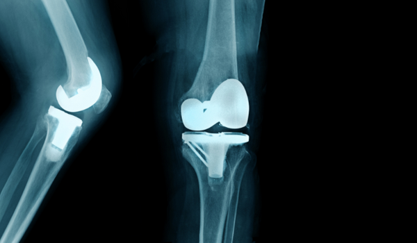 What is a Total Knee Replacement?