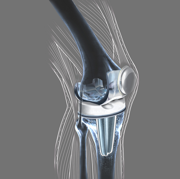 How Does a Knee Replacement Stay in Place? Can It Become Loose?